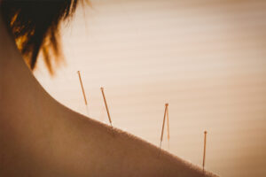 Acupuncture an ancient art